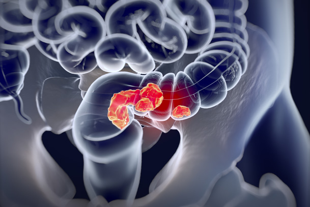 Best Practice Update: Colorectal Cancer Management