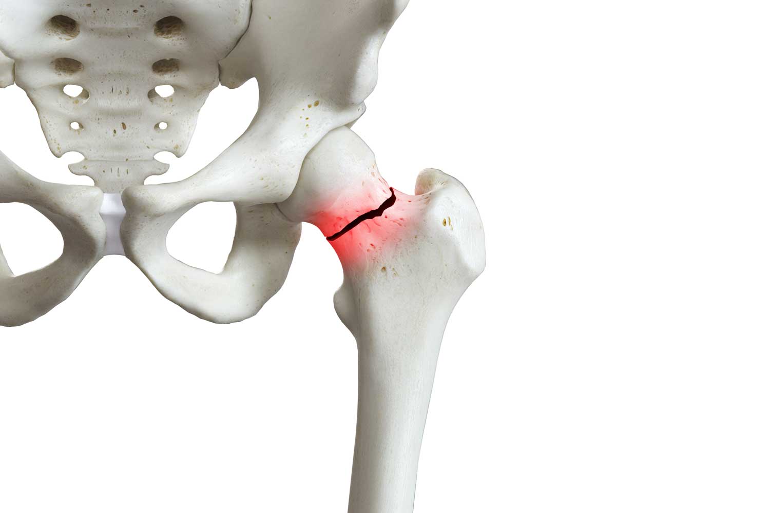 Achieving Best Practice for Hip Fractures